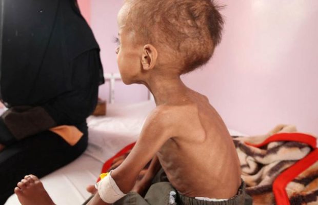 Yemen. El 75% de los niños yemenitas están crónicamente desnutridos, advierte OMS