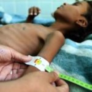 Yemen. Alrededor de 300 niños yemenitas mueren todos los días por desnutrición